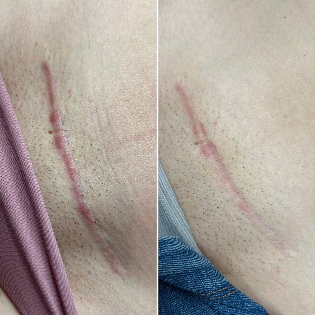 Terapia blizn, blizna po cesarce Przeźmierowo